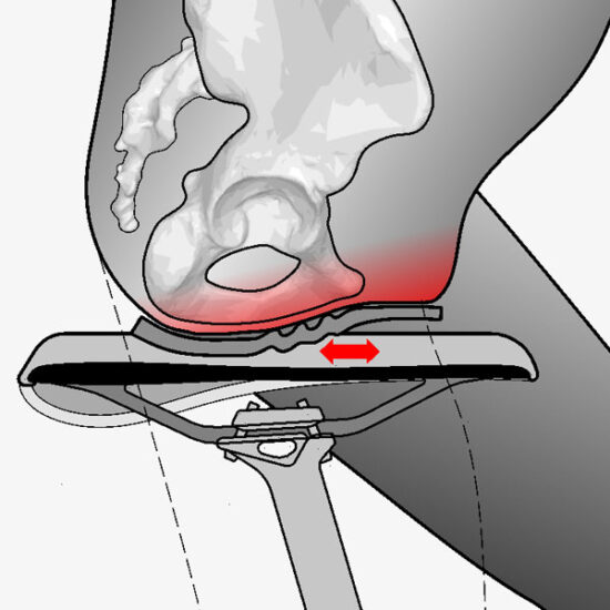 sitzpolster staucht sich in der radhose und bildet maulwurfshügel als störzone für reibung und wundscheuern